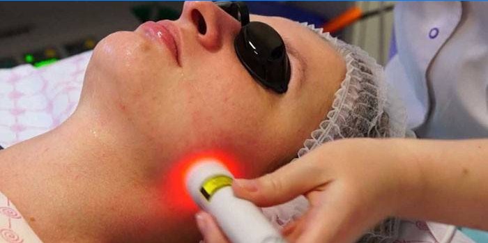 Lézer biorevitalizáció