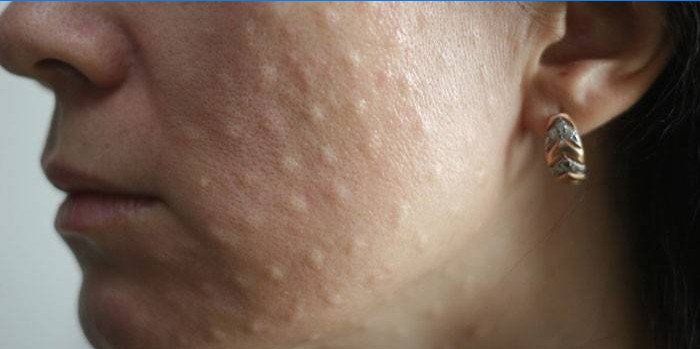 Komplikációk a biorevitalizáció után
