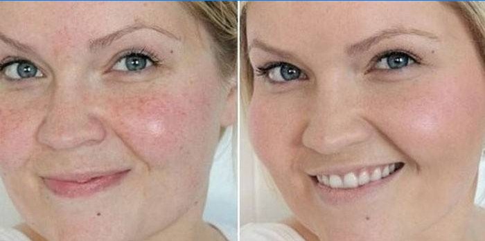 Bőr a nő arcán, kozmetikus tisztítás előtt és után