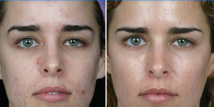 Bőr a lány arcán a kozmetikus általi mechanikus tisztítás előtt és után