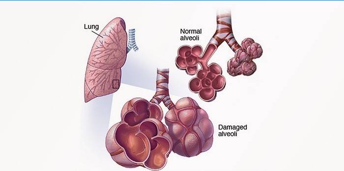 Exogén allergiás alveolitis