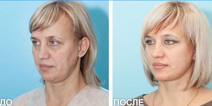 Fotó egy nőről az SMAS emelés előtt és után