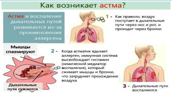 Hogyan fordul elő az asztma?